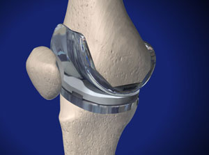 Approche d’un spécialiste du genou pour une remplacement total du genou ©Viewmedica