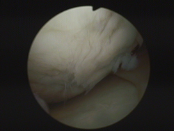 Image issue de l’arthroscopie d’un patient de 45 ans, avec des dommages clairement visibles sur la surface du cartilage d’une articulation du genou. La surface n’est plus lisse et solide mais rugueuse et vulnérable du fait des dégâts