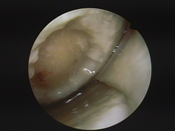 Même patient. Avant d’appliquer le nouveau cartilage sur la zone endommagée de l’articulation, le cartilage endommagé est retiré grâce à une opération arthroscopique.